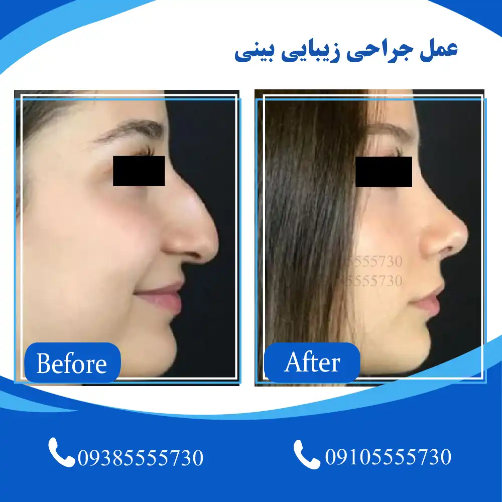 عمل بینی استخوانی تبریز