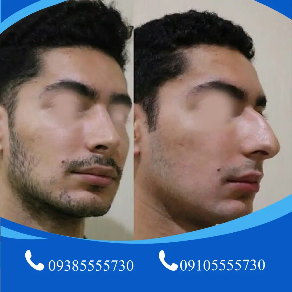 جراحی بینی تبریز