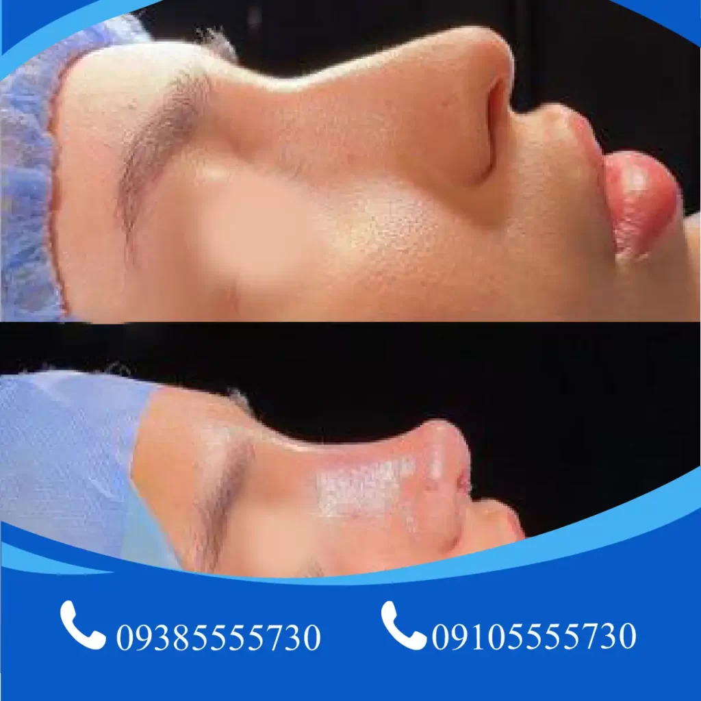عمل بینی در تبریز