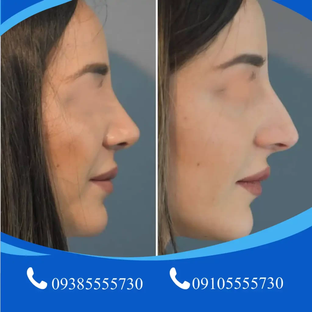 عمل بینی طبیعی در تبریز
