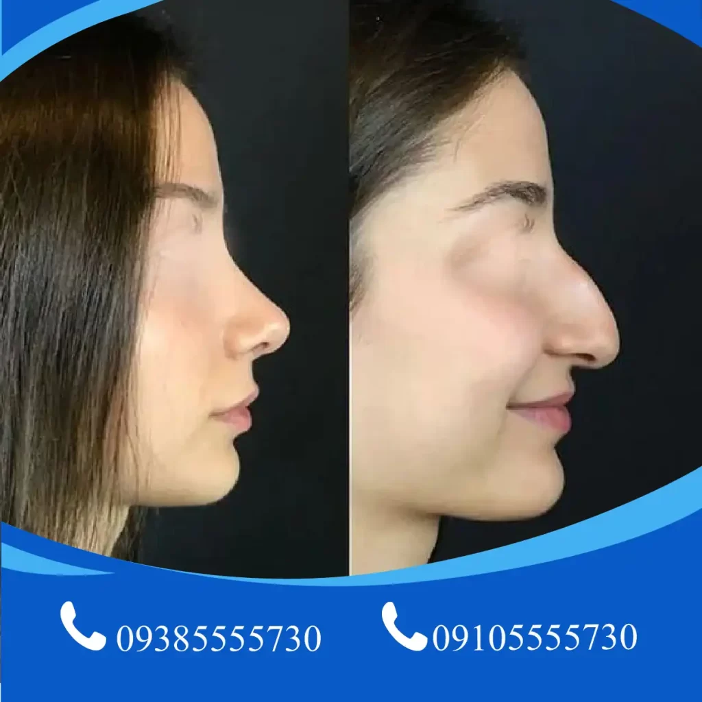 عمل بینی استخوانی در تبریز