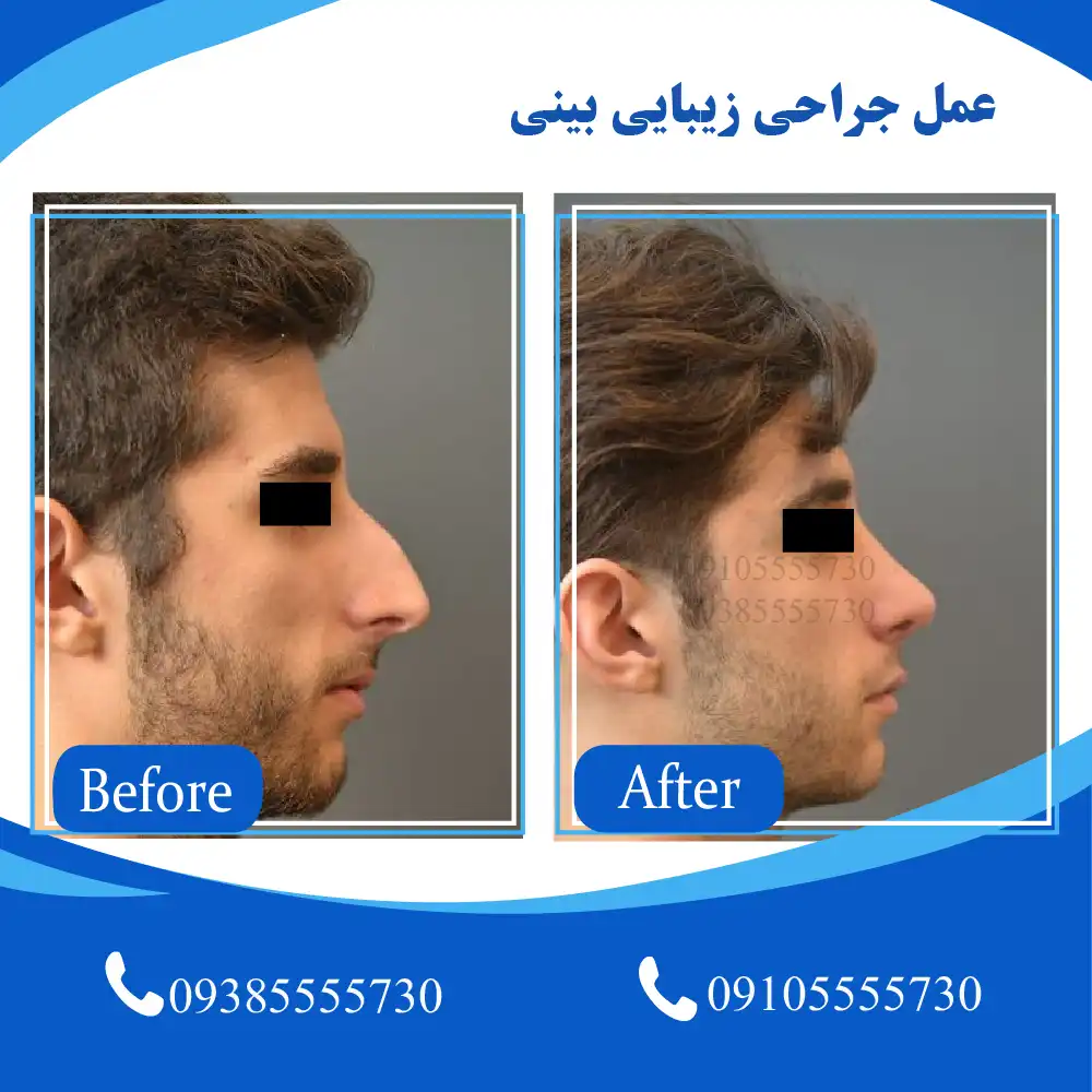 هزینه عمل بینی تبریز