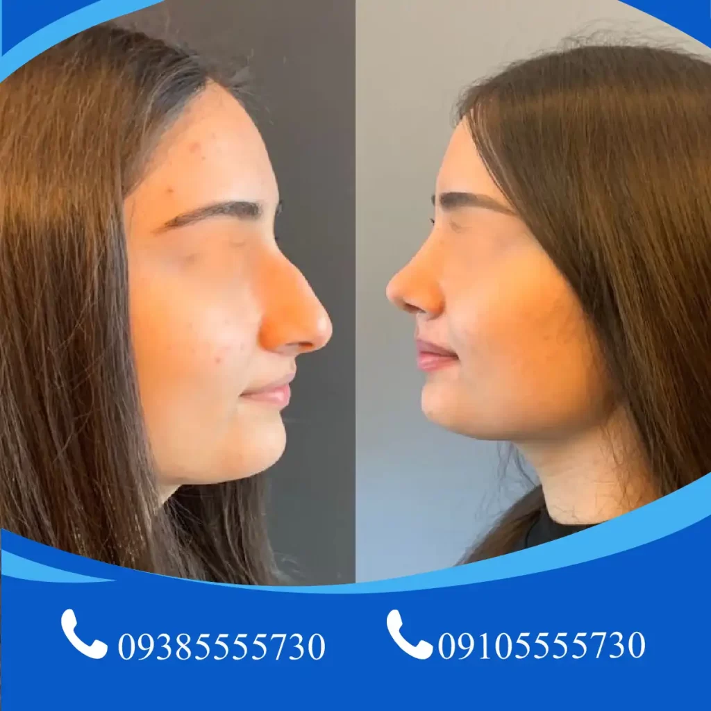 جراحی بینی گوشتی تبریز