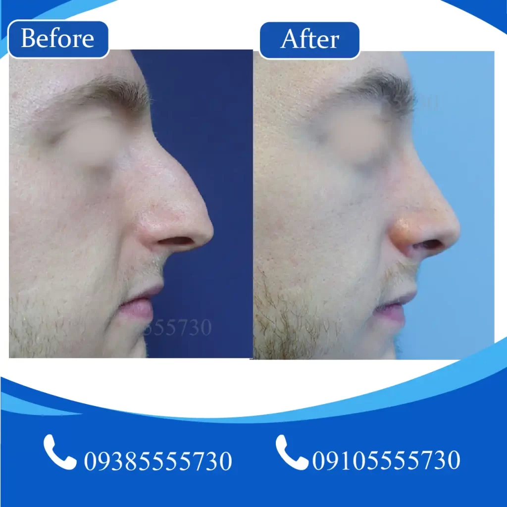 دکتر جراحی بینی گوشتی تبریز